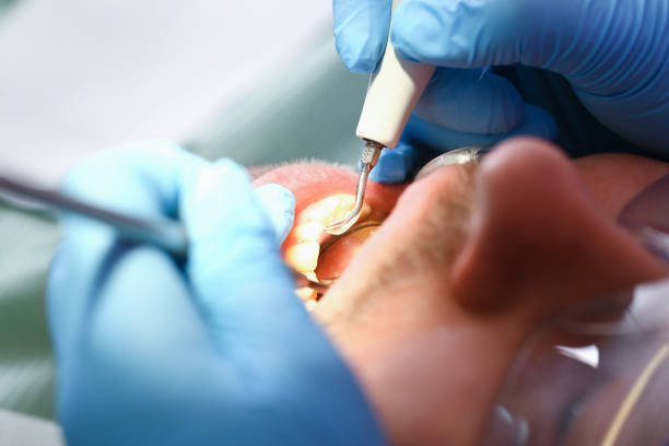 Best Emergency Dental Extractions in Berkeley, MO